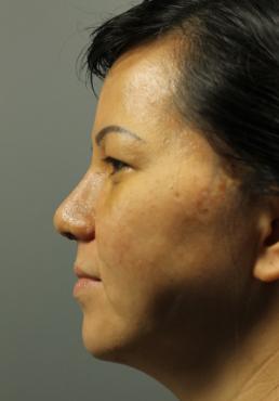 rhinoplasty-austin-tx