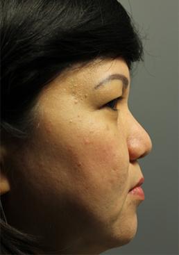 rhinoplasty-austin-tx