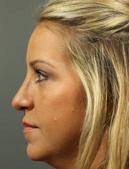 rhinoplasty-austin-tx