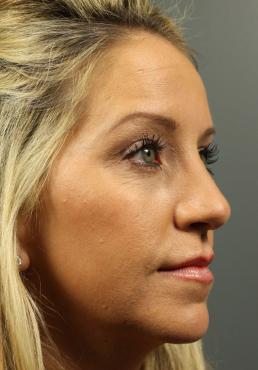 rhinoplasty-austin-tx