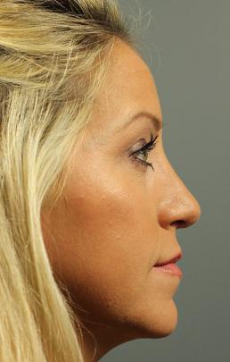 rhinoplasty-austin-tx