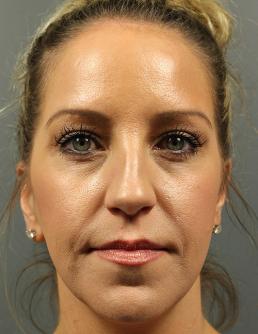 rhinoplasty-austin-tx