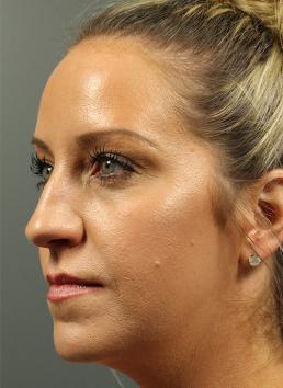 rhinoplasty-austin-tx