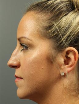 rhinoplasty-austin-tx