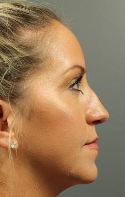 rhinoplasty-austin-tx