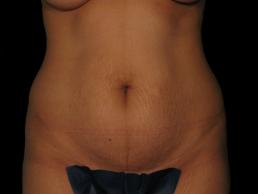 tummy-tuck-360-austin-tx