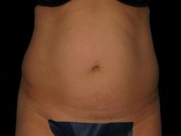 tummy-tuck-360-austin-tx