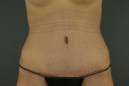 tummy-tuck-360-austin-tx