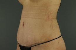 tummy-tuck-360-austin-tx