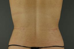 tummy-tuck-360-austin-tx