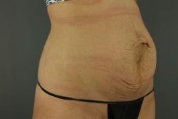 tummy-tuck-360-austin-tx