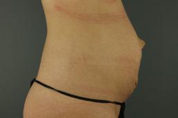 tummy-tuck-360-austin-tx