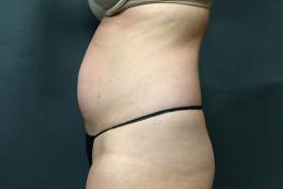 tummy-tuck-360-austin-tx