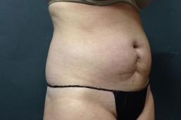 tummy-tuck-360-austin-tx