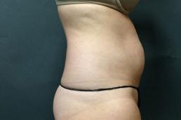 tummy-tuck-360-austin-tx