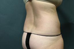 tummy-tuck-360-austin-tx