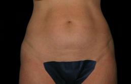 tummy-tuck-360-austin-tx