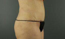 tummy-tuck-360-austin-tx