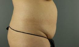 tummy-tuck-360-austin-tx