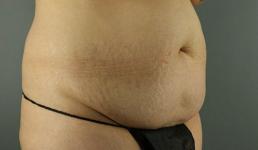 tummy-tuck-360-austin-tx