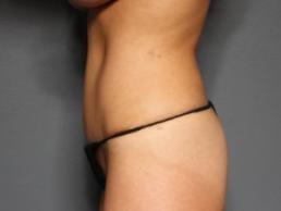 tummy-tuck-360-austin-tx