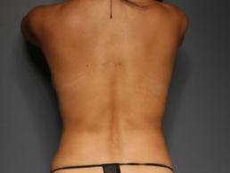 tummy-tuck-360-austin-tx