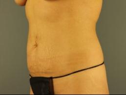 tummy-tuck-360-austin-tx