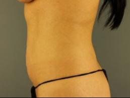 tummy-tuck-360-austin-tx