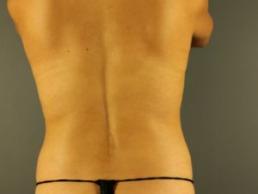 tummy-tuck-360-austin-tx