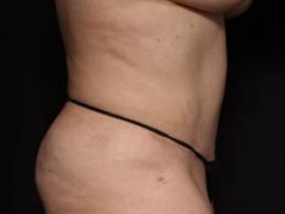 tummy-tuck-360-austin-tx