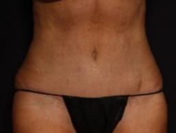 tummy-tuck-360-austin-tx