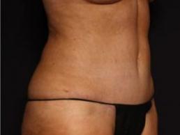 tummy-tuck-360-austin-tx