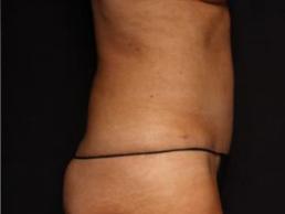 tummy-tuck-360-austin-tx