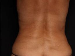 tummy-tuck-360-austin-tx