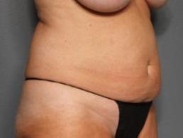 tummy-tuck-360-austin-tx