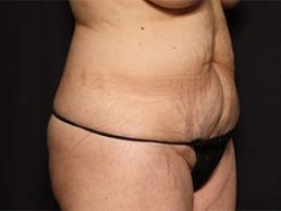 tummy-tuck-360-austin-tx