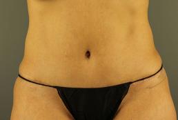 tummy-tuck-360-austin-tx
