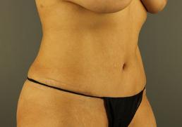 tummy-tuck-360-austin-tx
