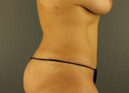 tummy-tuck-360-austin-tx