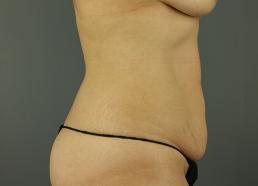 tummy-tuck-360-austin-tx