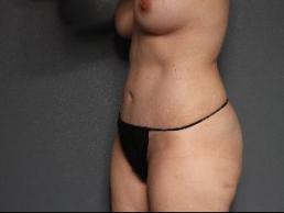 tummy-tuck-austin-tx