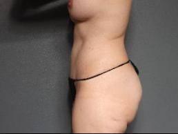 tummy-tuck-austin-tx