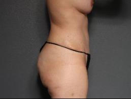 tummy-tuck-austin-tx