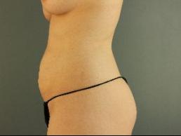 tummy-tuck-austin-tx