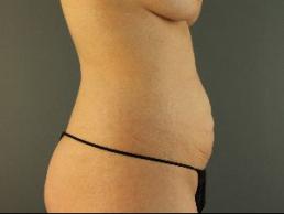 tummy-tuck-austin-tx