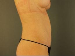 tummy-tuck-austin-tx