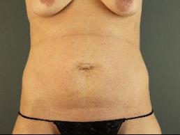 tummy-tuck-austin-tx