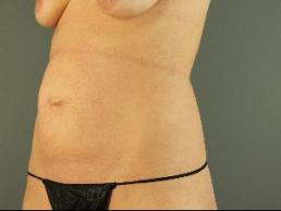 tummy-tuck-austin-tx