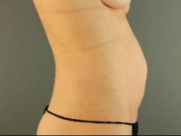 tummy-tuck-austin-tx
