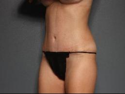 tummy-tuck-austin-tx